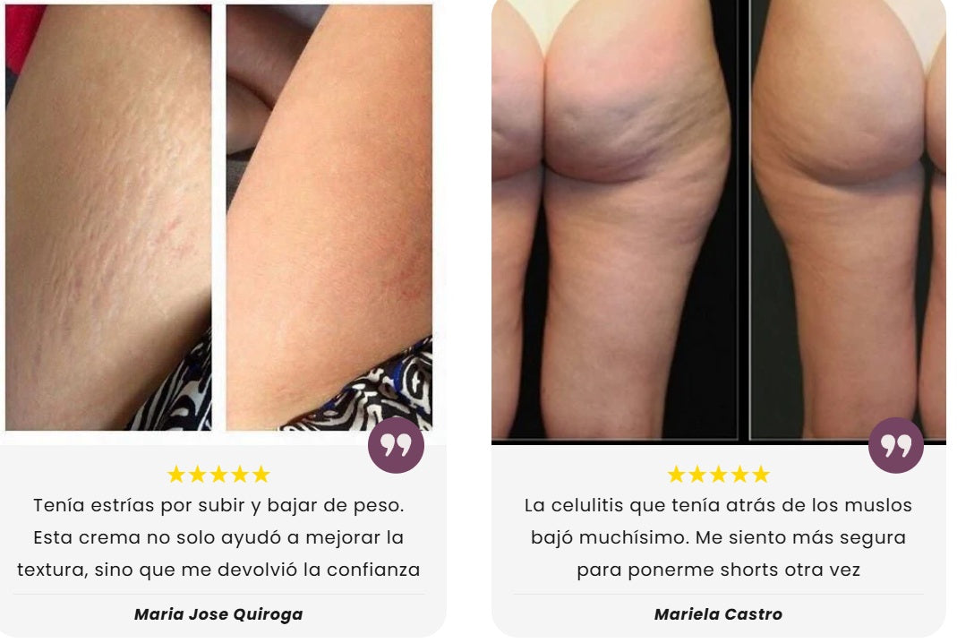 AntiCelulitis, AntiEstrías y Reafirmante de piel - Aceite con Extracto de Plantas Naturales