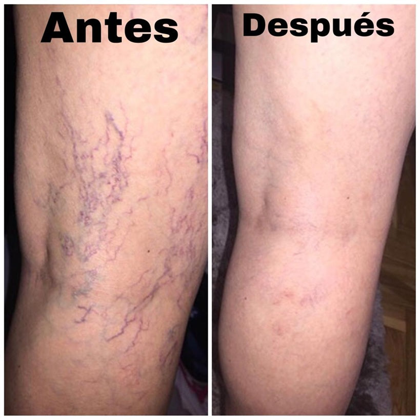 Spray Anti-Varices 100% Natural